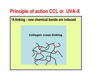 Principle of action CCL or  UVA-X   X-linking : new chemical bonds are   induced Collagen cross-linking 