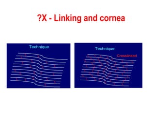 X - Linking and cornea? 