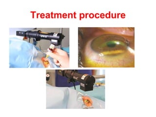 Treatment procedure 