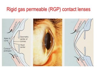 Rigid gas permeable (RGP) contact lenses 