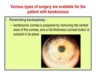 Various types of surgery are available for the patient with keratoconus Penetrating keratoplasty :   keratoconic cornea is prepared by removing the central area of the cornea, and a full - thickness corneal button is sutured in its place 