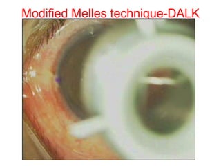 Modified Melles technique-DALK 