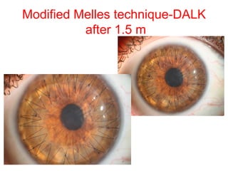 Modified Melles technique-DALK after 1.5 m   