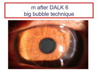 6 m after DALK  big bubble technique 