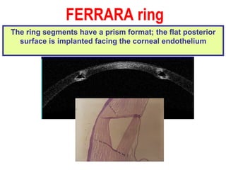 The ring segments have a prism format; the flat posterior surface is implanted facing the corneal endothelium FERRARA ring   