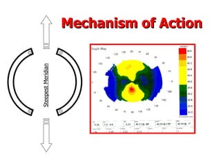 Mechanism of Action Steepest Meridian 