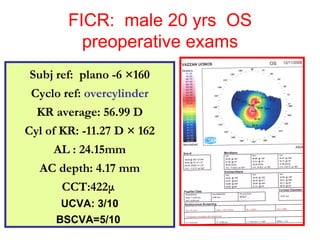 FICR:  male 20 yrs  OS preoperative exams Subj ref:  plano -6  × 160 Cyclo ref:  overcylinder KR average: 56.99 D Cyl of KR: -11.27 D  ×  162 AL : 24.15mm AC depth: 4.17 mm CCT:422 μ  UCVA: 3/10 BSCVA=5/10   
