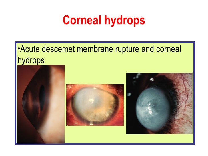 keratoconus