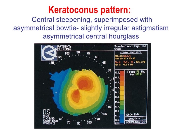 keratoconus