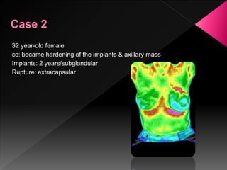 32 year-old female
cc: became hardening of the implants & axillary mass
Implants: 2 years/subglandular
Rupture: extracapsular
 