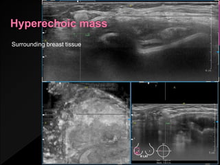 Surrounding breast tissue
 