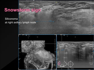Siliconoma
at right axillary lymph node
 