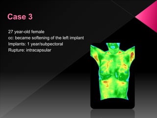 27 year-old female
cc: became softening of the left implant
Implants: 1 year/subpectoral
Rupture: intracapsular
 
