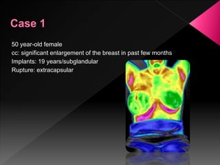 50 year-old female
cc: significant enlargement of the breast in past few months
Implants: 19 years/subglandular
Rupture: extracapsular
 