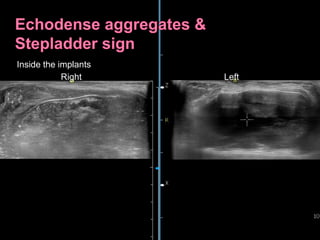 Inside the implants
Right Left
 