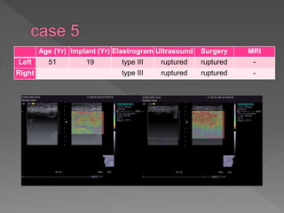 Age (Yr) Implant (Yr) Elastrogram Ultrasound Surgery MRI
Left 51 19 type III ruptured ruptured -
Right type III ruptured ruptured -
 