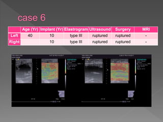 Age (Yr) Implant (Yr) Elastrogram Ultrasound Surgery MRI
Left 40 10 type III ruptured ruptured -
Right 10 type III ruptured ruptured -
 