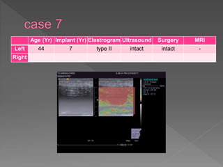 Age (Yr) Implant (Yr) Elastrogram Ultrasound Surgery MRI
Left 44 7 type II intact intact -
Right
 