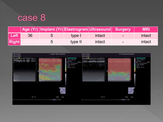 Age (Yr) Implant (Yr) Elastrogram Ultrasound Surgery MRI
Left 36 5 type I intact - intact
Right 5 type II intact - intact
 
