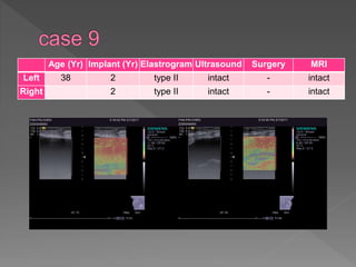 Age (Yr) Implant (Yr) Elastrogram Ultrasound Surgery MRI
Left 38 2 type II intact - intact
Right 2 type II intact - intact
 