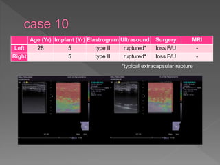 Age (Yr) Implant (Yr) Elastrogram Ultrasound Surgery MRI
Left 28 5 type II ruptured* loss F/U -
Right 5 type II ruptured* loss F/U -
*typical extracapsular rupture
 