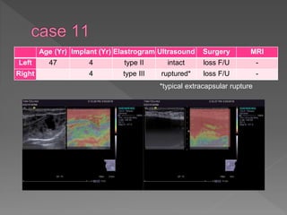 Age (Yr) Implant (Yr) Elastrogram Ultrasound Surgery MRI
Left 47 4 type II intact loss F/U -
Right 4 type III ruptured* loss F/U -
*typical extracapsular rupture
 