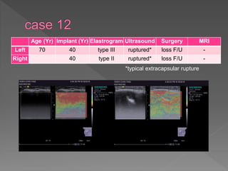 Age (Yr) Implant (Yr) Elastrogram Ultrasound Surgery MRI
Left 70 40 type III ruptured* loss F/U -
Right 40 type II ruptured* loss F/U -
*typical extracapsular rupture
 