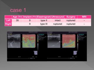 Age (Yr) Implant (Yr) Elastrogram Ultrasound Surgery MRI
Left 35 9 type II intact ruptured -
Right 9 type III ruptured ruptured -
 