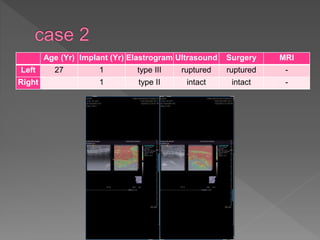 Age (Yr) Implant (Yr) Elastrogram Ultrasound Surgery MRI
Left 27 1 type III ruptured ruptured -
Right 1 type II intact intact -
 