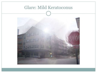 Glare: Mild Keratoconus<br />