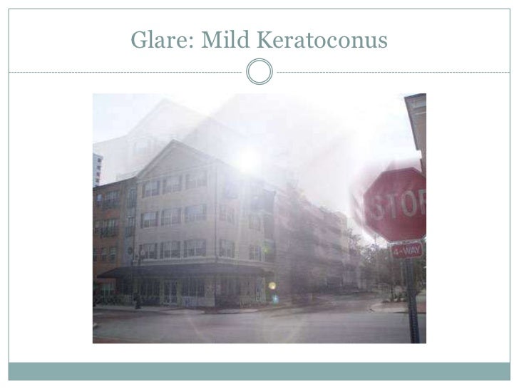 Keratoconus Through the Eyes of a Patient