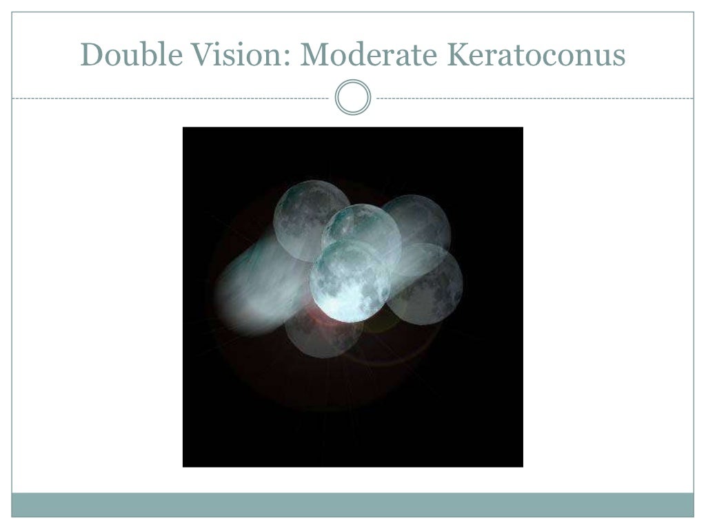 Keratoconus Through the Eyes of a Patient