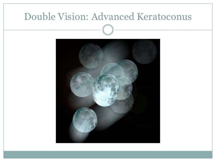 Keratoconus Through the Eyes of a Patient