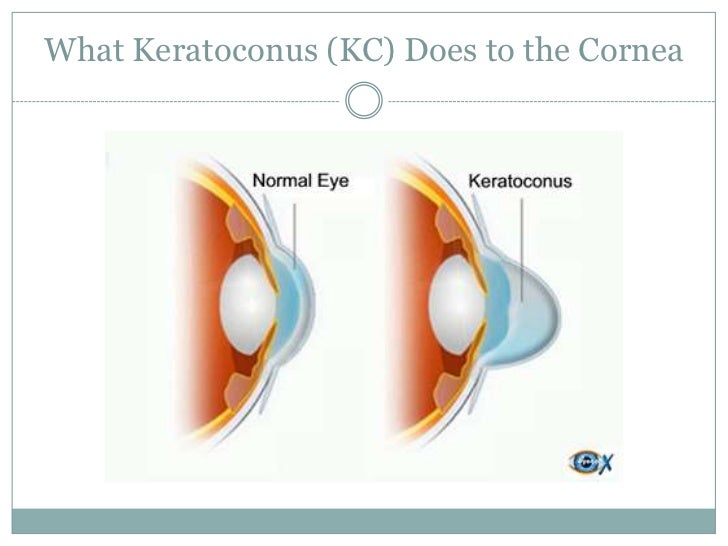 What is keratoconus eye disease?