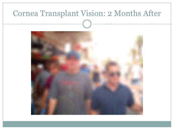 Keratoconus Through the Eyes of a Patient