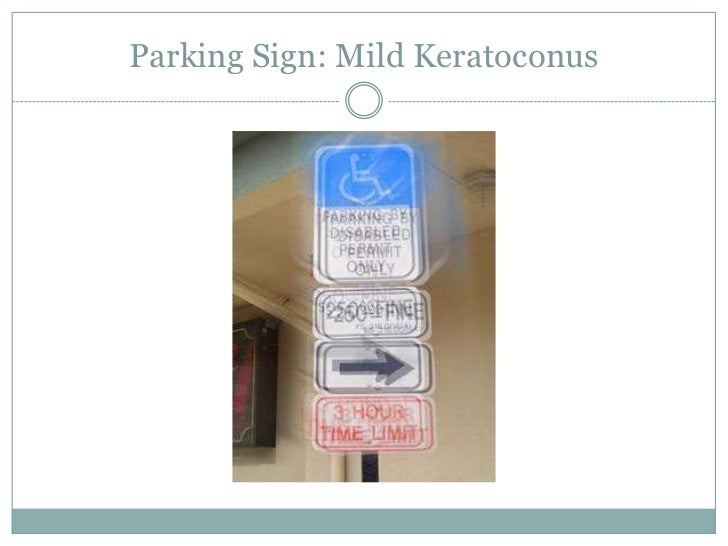 Keratoconus Through the Eyes of a Patient