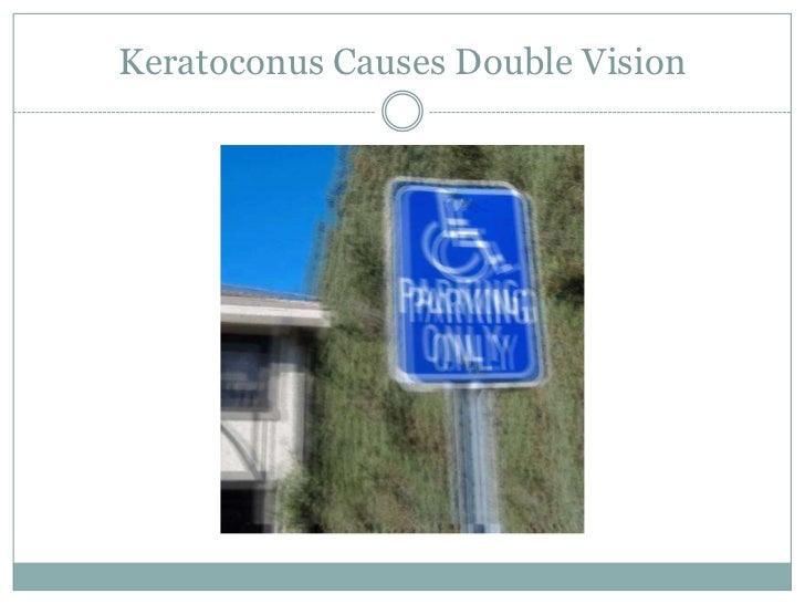 Keratoconus Through the Eyes of a Patient