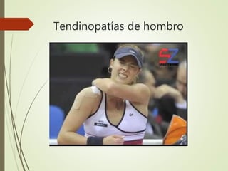 Tendinopatías de hombro
 