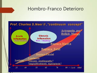 Hombro-Franco Deterioro
 
