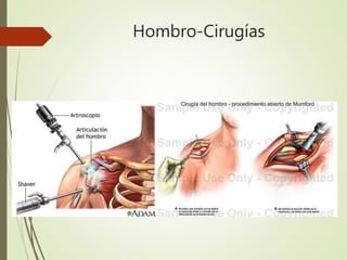 Hombro-Cirugías
 