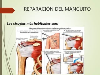REPARACIÓN DEL MANGUITO
Las cirugías más habituales son:
 