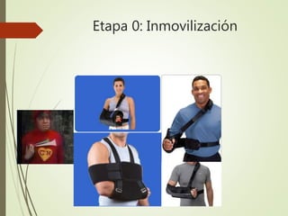Etapa 0: Inmovilización
 