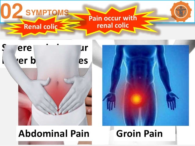 Kidney Stones Renal Calculi
