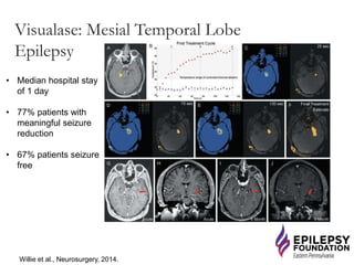 Visualase: Mesial Temporal Lobe
Epilepsy
• Median hospital stay
of 1 day
• 77% patients with
meaningful seizure
reduction
• 67% patients seizure
free
Willie et al., Neurosurgery, 2014.
 