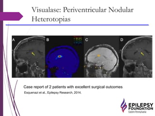 Visualase: Periventricular Nodular
Heterotopias
Case report of 2 patients with excellent surgical outcomes
Esquenazi et al., Epilepsy Research, 2014.
 