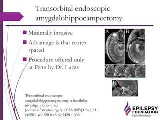 Transorbital endoscopic
amygdalohippocampectomy
 Minimally invasive
 Advantage is that cortex
spared
 Procedure offered only
at Penn by Dr. Lucas
Transorbital endoscopic
amygdalohippocampectomy: a feasibility
investigation. Source:
Journal of neurosurgery [0022-3085] Chen, H I
yr:2014 vol:120 iss:6 pg:1428 -1436
 