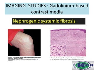 IMAGING STUDIES : Gadolinium-based
contrast media
Nephrogenic systemic fibrosis
 