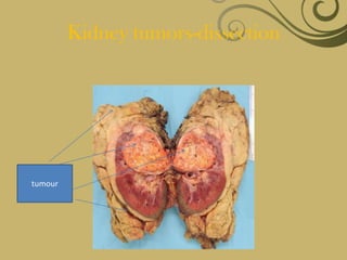 Kidney tumors-dissection




tumour
 
