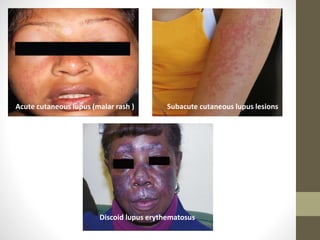 Subacute cutaneous lupus lesions
Discoid lupus erythematosus
Acute cutaneous lupus (malar rash )
 
