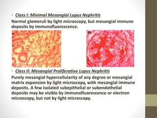• Class I: Minimal Mesangial Lupus Nephritis
Normal glomeruli by light microscopy, but mesangial immune
deposits by immunofluorescence.
• Class II: Mesangial Proliferative Lupus Nephritis
Purely mesangial hypercellularity of any degree or mesangial
matrix expansion by light microscopy, with mesangial immune
deposits. A few isolated subepithelial or subendothelial
deposits may be visible by immunofluorescence or electron
microscopy, but not by light microscopy.
 